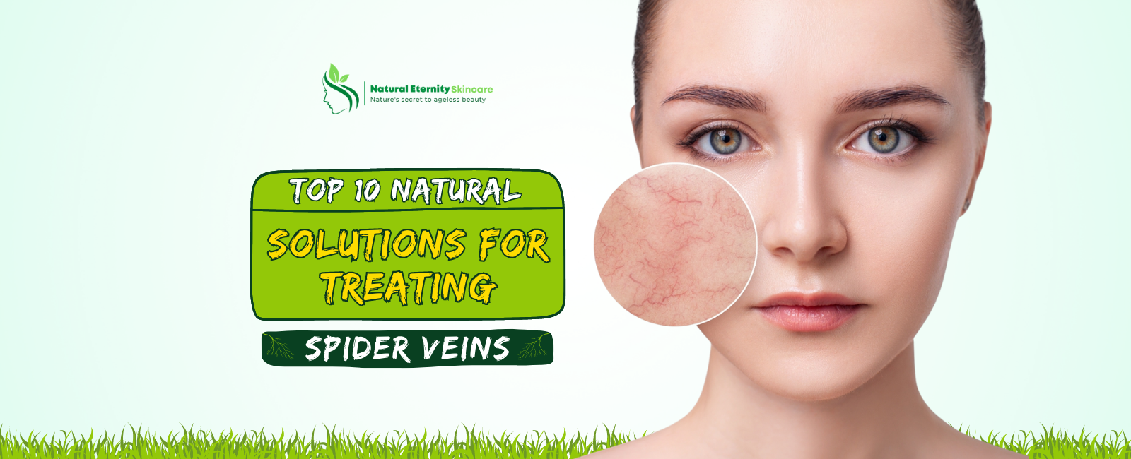 Natural Remedies for Spider Veins